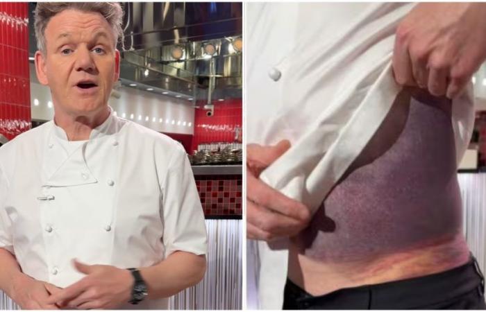 Unfall für Gordon Ramsay, der Koch zeigt blaue Flecken und sagt: „Ich habe Glück, noch am Leben zu sein, ich sehe aus wie eine lila Kartoffel“