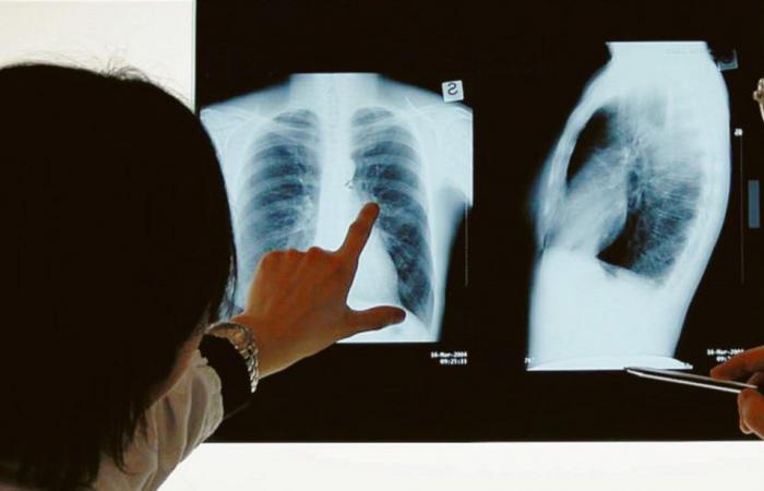 Tuberkulose, dringender Appell an Institutionen, den Zugang zur Behandlung zu verbessern