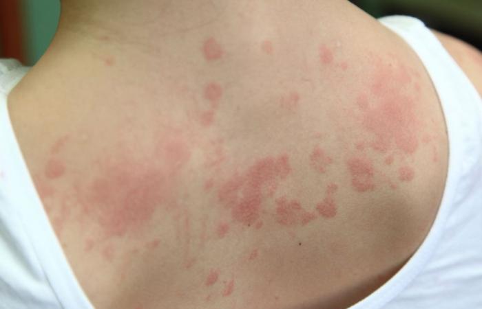 Was sind die ersten Symptome einer Allergie?