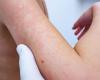 Hier erfahren Sie, was Rötungen auf der Haut sind und warum sie auftreten: Sie können auch entfernt werden