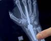 Bari, die erste Handgelenkprothese im gesamten Süden wurde implantiert: „Jetzt bewegt der Patient das Glied und hat keine Schmerzen mehr“