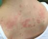 Was sind die ersten Symptome einer Allergie?